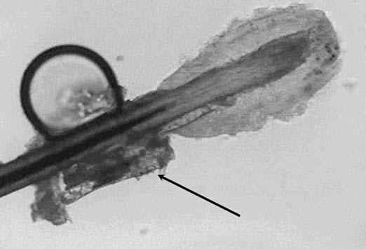 Mite  eyelash infection