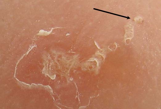 Mite skin burrows