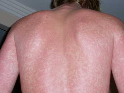 Dengue fever skin rash